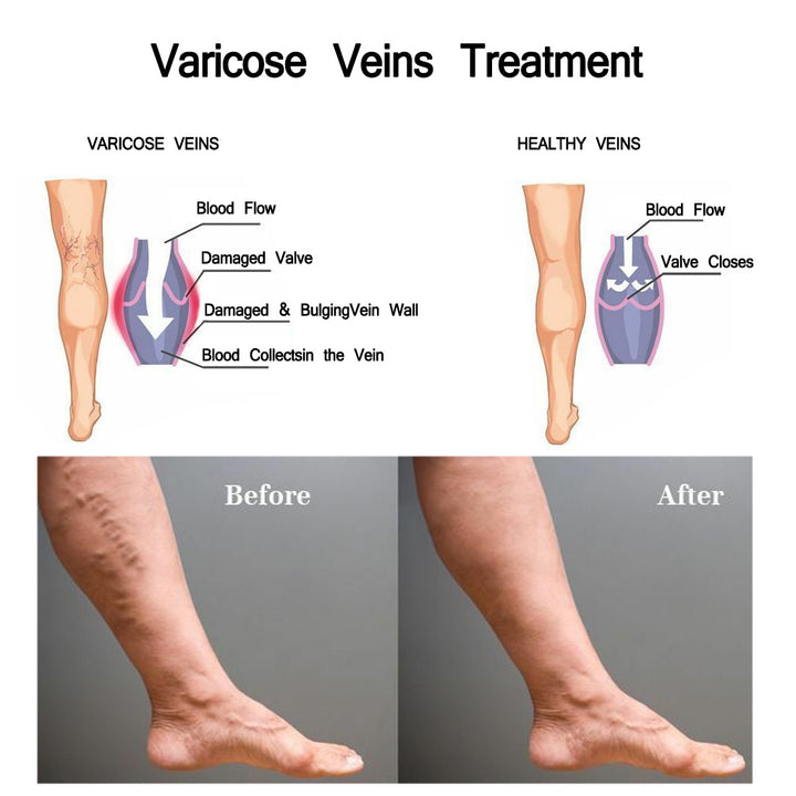 Varicose Cream