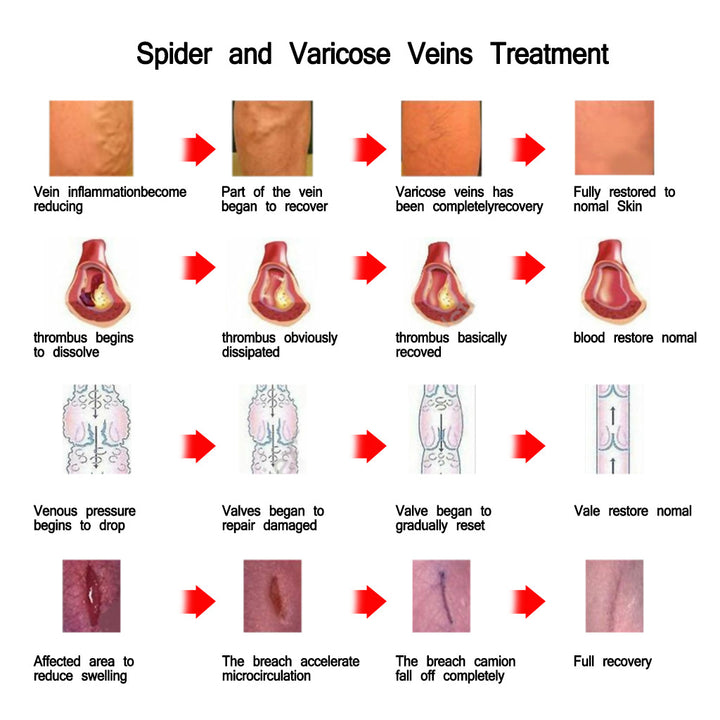 Varicose Cream