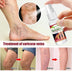 Varicose Veins Treatment Spray